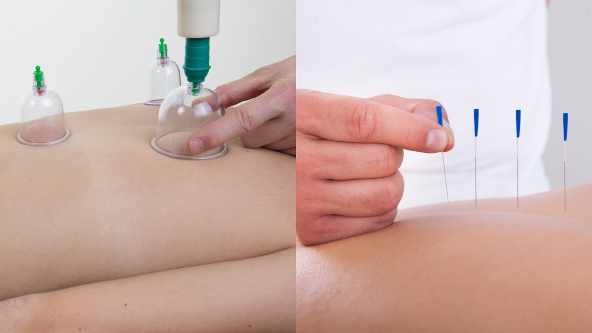 Manfaat Bekam Akupuntur: Penyembuhan Sakit & Relaksasi – Teknik Tradisional Efektif